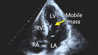 Transthoracic Echocardiogram [upl. by Nirehtak833]