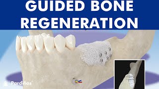 Guided bone regeneration  Bone graft © [upl. by Drona]