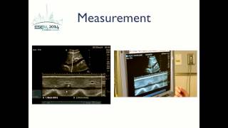 Inferior Vena Cava Ultrasound [upl. by Ahsemad]