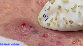 TREATMENT BLACKHEADS 90  Loan Nguyen [upl. by Zindman911]