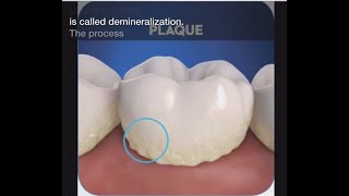 Stage 1 of Tooth Decay Demineralization [upl. by Olen]