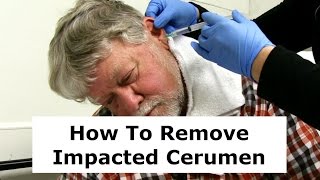 Removing Impacted Cerumen from a Patients Ear [upl. by Anaerda]