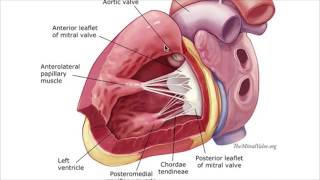 Post MI cardiac rupturepapillary muscle [upl. by Camilia338]