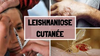 LA LEISHMANIOSE CUTANNÉ  CAUSES  SYPMTOMES  COMPLICATIONS  TRAITEMENT [upl. by Akiaki64]