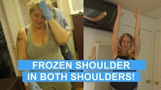 FROZEN SHOULDER IN BOTH ARMS Fixed By Trigenics OAT Procedure [upl. by Hegyera]