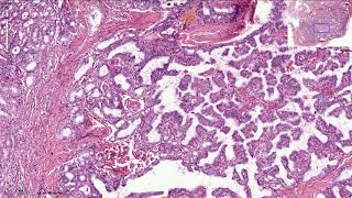 Papillary Thyroid Carcinoma  Histopathology [upl. by Laval]