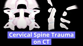 Cervical Spine Trauma on CT [upl. by Bordie]