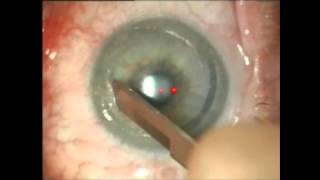 Limbal Relaxing Incisions to treat corneal astigmatism during cataract surgery [upl. by Eselehs]