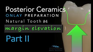 Zirconia Ceramics Part 2 Posterior Ceramic Onlay Preparation  Margin Elevation [upl. by Eibor366]