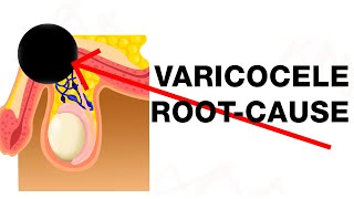 Varicocele Treat the RootCause [upl. by Guthry]