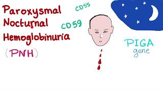 Paroxysmal Nocturnal Hemoglobinuria PNH  Hemolytic Anemia  Complement Alternative Pathway [upl. by Debor]