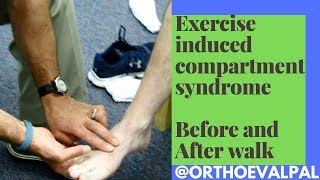 Exercise Induced Compartment Syndrome Signs and Symptoms [upl. by Snoddy]