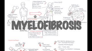 Myelofibrosis Disease Overview and Treatment Options [upl. by Hnim]