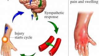 Complex Regional Pain Syndrome CRPS [upl. by Anton]