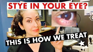 STYES  What are they and how are they treated  The Eye Surgeon [upl. by Pall]