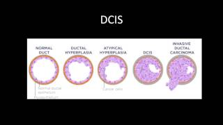 Breast Cancer Review Series DCIS and IDC [upl. by Alyhc172]