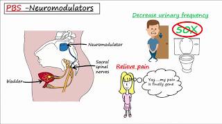 Painful Bladder Syndrome PBS  Interstitial Cystitis IC [upl. by Ansilme]