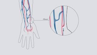 Understanding hemodialysis [upl. by Enihpled431]