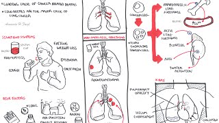 Lung Cancer  Overview [upl. by Washburn771]