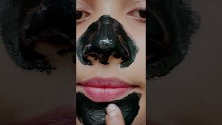 DIY Blackheads amp Whiteheads at Home 💯 ✅ l shortsyoutubeshorts trendinghackshomemade diy [upl. by Elvis]