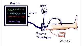 Compartment pressure measurement  Aline technique [upl. by Norling]