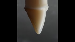 All Ceramic Crown Preparation for Emax and Zirconia [upl. by Nikolas]