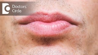 What causes discoloration below lip amp its management  Dr Sachith Abraham [upl. by Elfont947]