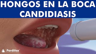 CANDIDIASIS oral y BOQUERAS  Cómo CURAR los hongos de la boca © [upl. by Eon]