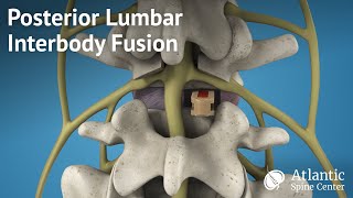 Posterior Lumbar Interbody Fusion PLIF [upl. by Nabatse]