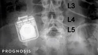 Meralgia Paresthetica Soft Tissue Release  TFL and Psoas Chiropractic Treatment [upl. by Rawdon]