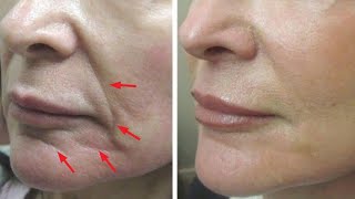 Just 2 skin tightening and face lifting home remedies [upl. by Psyche]