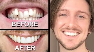 INVISALIGN REVIEW  everything you need to know [upl. by Adniles]