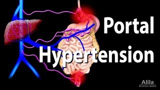 Portal Hypertension Animation [upl. by Lukasz914]