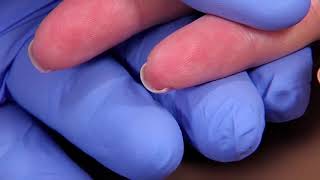 Perform a Capillary Puncture Obtain a Blood Sample by Capillary Puncture [upl. by Atineb]