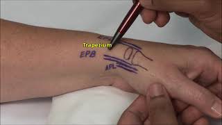 1st CMC Joint Injection [upl. by Pate236]