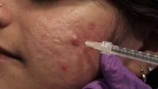 Watch amp Learn Intralesional injections [upl. by Havstad]