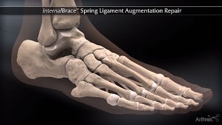 InternalBrace™ Spring Ligament Augmentation Repair [upl. by Freudberg746]