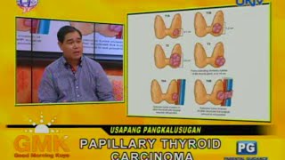 Papillary Thyroid Carcinoma [upl. by Lenoj]