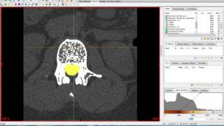 Materialise Mimics and 3Matic Tutorial [upl. by Nivej]