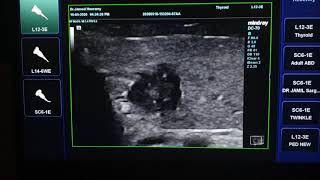 Papillary Thyroid Cancer Ultrasound [upl. by Ellemac]