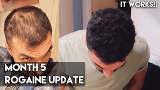 5 Month Rogaine Update Minoxidil  IT WORKS [upl. by Lander547]