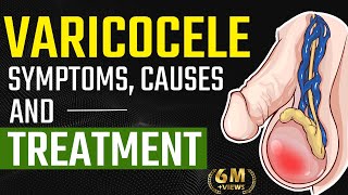 Varicocele Symptoms Causes and Treatment  Varicocele Natural Treatment  Testis Pain Relief [upl. by Nnylyoj]