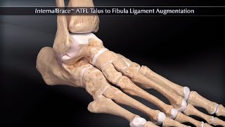 InternalBrace™ ATFL Talus to Fibula Ligament Augmentation [upl. by Bazil]