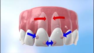 Discover how Invisalign works [upl. by Lavinie]