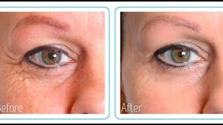 Hyaluronic Acid Before And After MY RESULTS [upl. by Thekla]