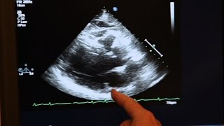 Echocardiogram Demonstration [upl. by Aitnom404]