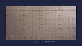 Electrical Alternans ECG [upl. by Madelina911]