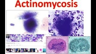 Actinomycosis Medschooltutorial [upl. by Ylrahc]