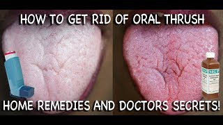 How to Treat Candida at Home Doctors Advice [upl. by Aenil]