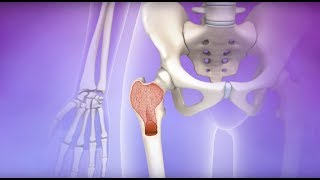 Understanding Myelodysplastic Syndromes MDS [upl. by Wincer]